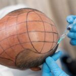 Die 10 besten Haartransplantationskliniken in Deutschland